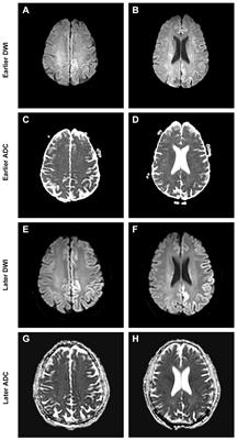 IgLON5 autoimmunity in a patient with Creutzfeldt–Jakob disease: case report and review of literature